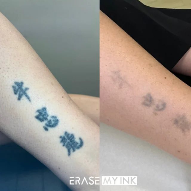 can laser tattoo removal remove coloured tattoos?